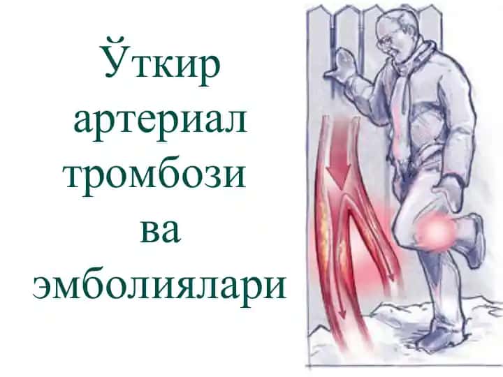Ўткир артериал тромбози ва эмболиялари