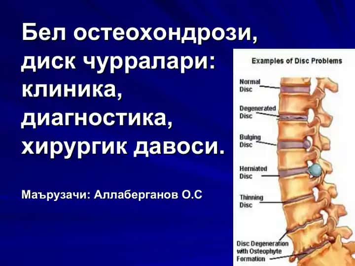 Бел остеохондрози, диск чурралари: клиника, диагностика, хирургик давоси