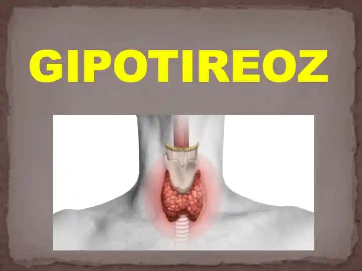 GIPOTIREOZ