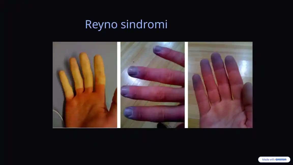 Reyno sindromi