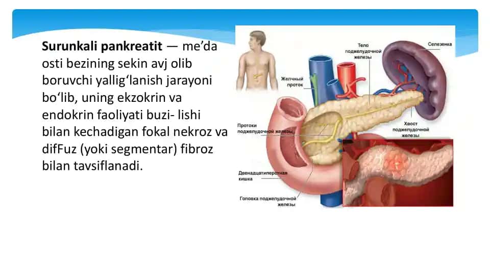 Surunkali pankreatit