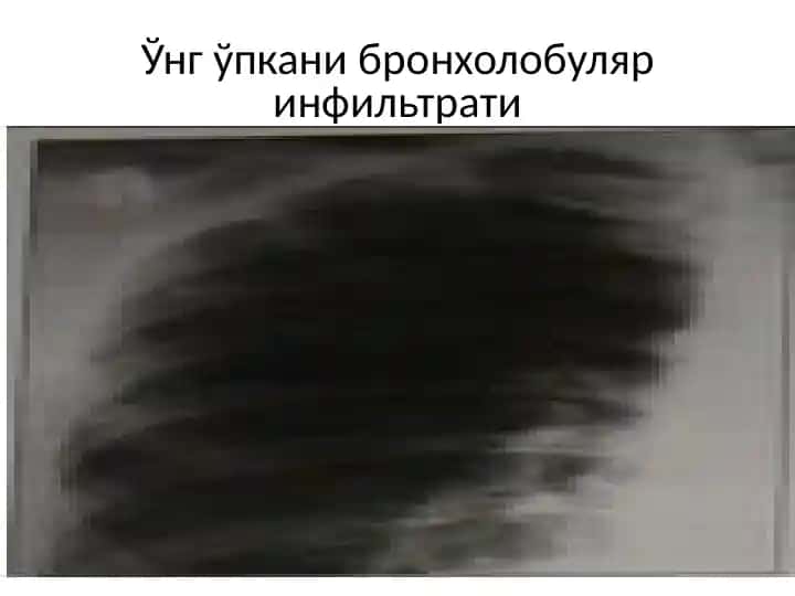 Ўнг ўпкани бронхолобуляринфильтрати