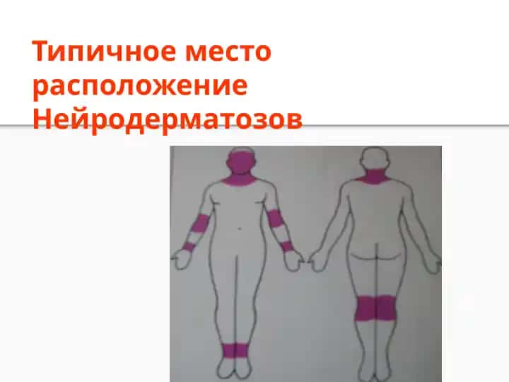 Нейродерматозов