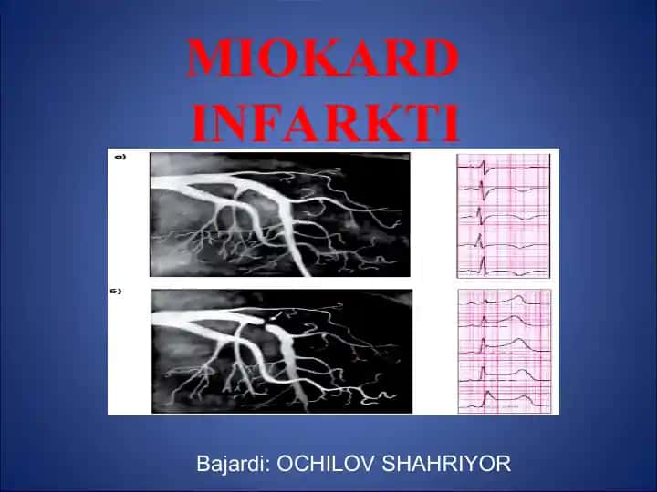 MIOKARD INFARKTI