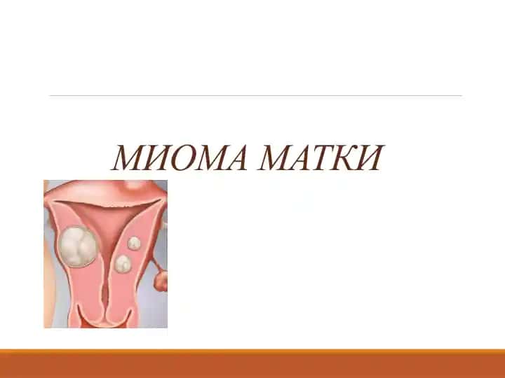 Миома матки,Bachadon Miomasi