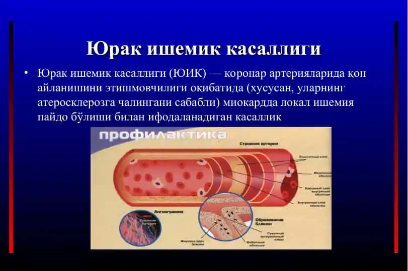 Юрак ишемик касаллиги