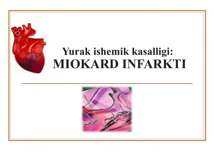 MIOKARD INFARKTI