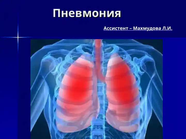 Пневмония