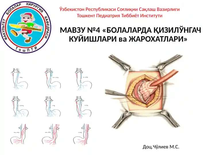"БОЛАЛАРДА ҚИЗИЛЎНГАЧ КУЙИШЛАРИ ва ЖАРОХАТЛАРИ"