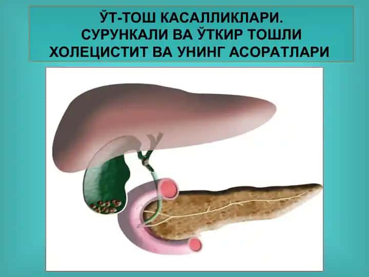 Ўт-тошкасалликлари. Сурункали ваўткир тошли холецистит ва унинг асоратлари