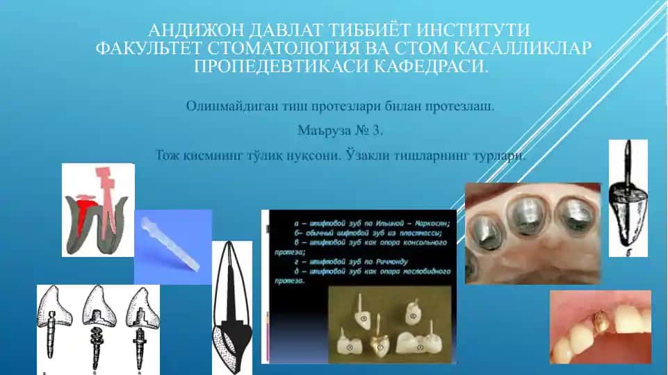 Olinmagan tish protezlarining prostezlash (маъруза № 3)