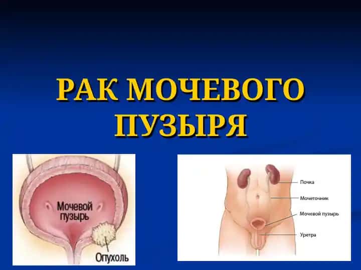 РАК МОЧЕВОГО ПУЗЫРЯ
