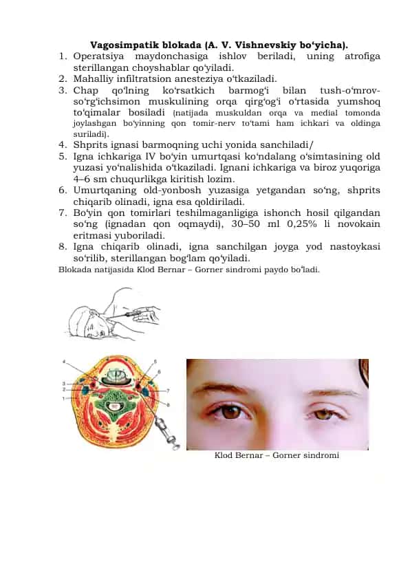 Vagosimpatik blokada (A. V. Vishnevskiy bo‘yicha)