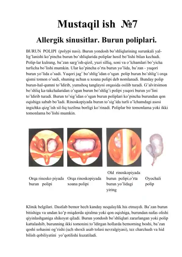 Burun Polipi
