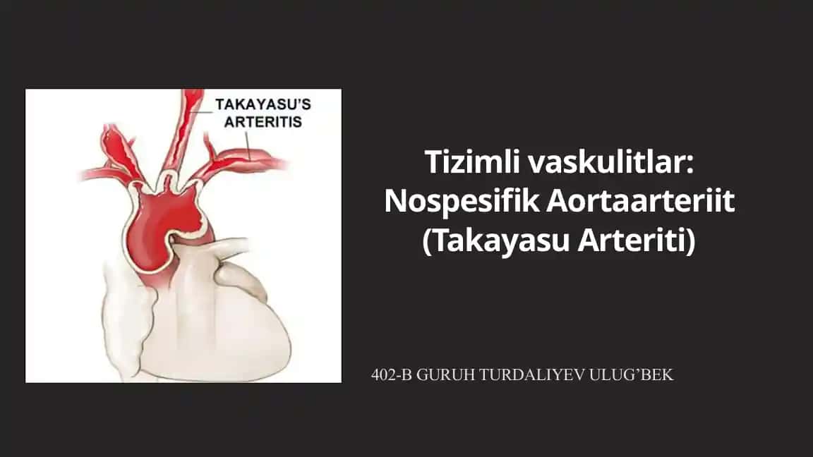 Tizimli vaskulitlar: Nospesifik Aortaarteriit (Takayasu Arteriti)