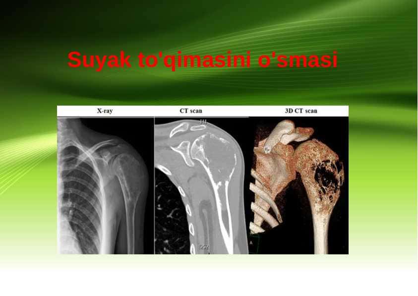 Suyak to‘qimasi o‘smasi