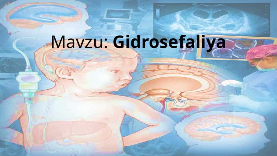 Gidrosefaliya