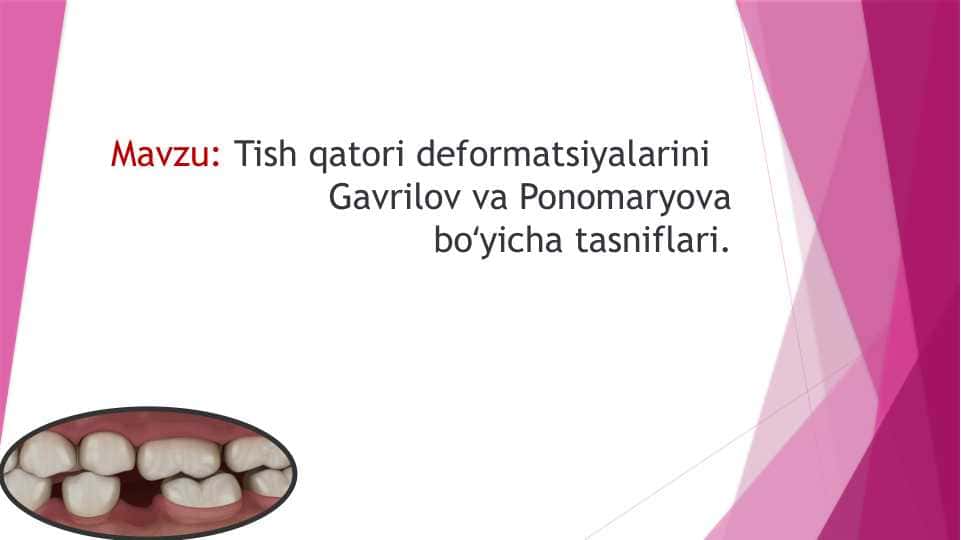 Tish qatori deformatsiyalarini Gavrilov va Ponomaryova boʻyicha tasniflari