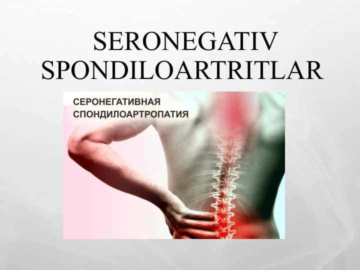 SERONEGATIV SPONDILOARTRITLAR