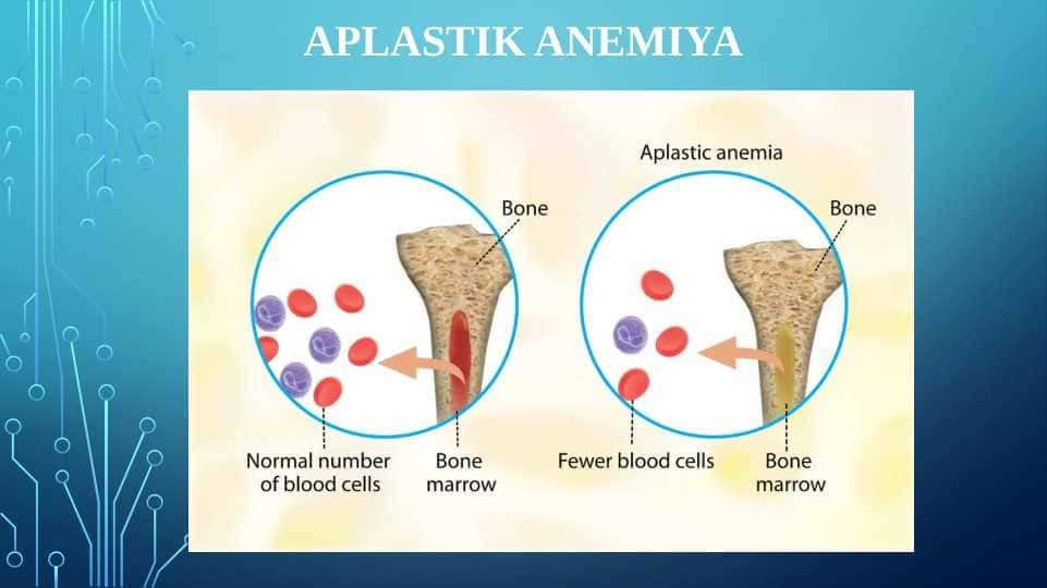 APLASTIK ANEMIYA