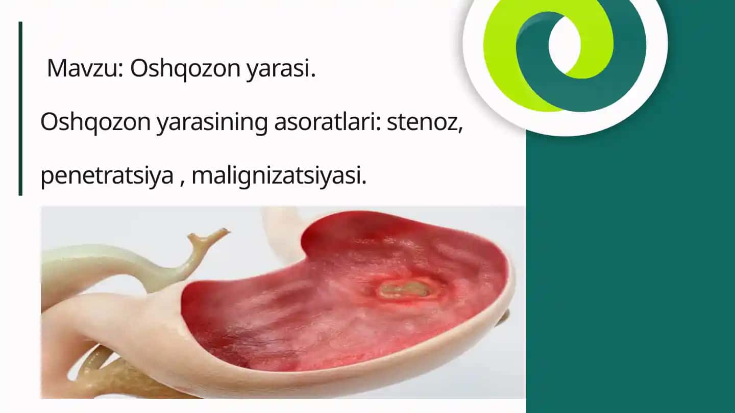 Oshqozonyarasi
