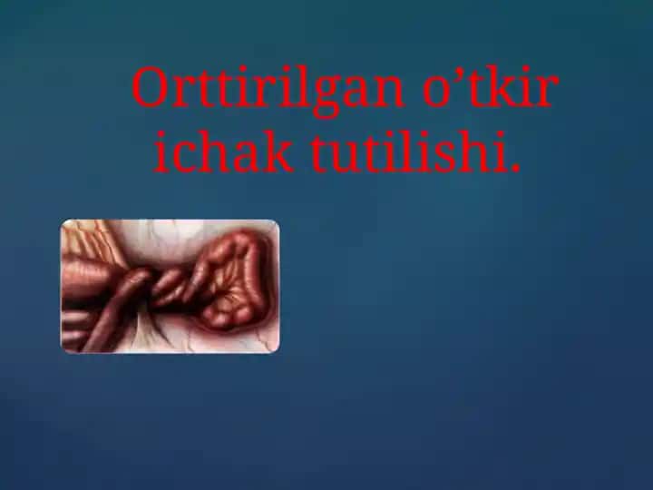 Orttirilgan o’tkir ichak tutilishi