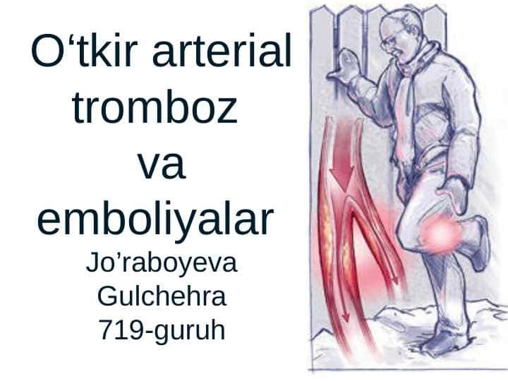 Tromboz va emboliya