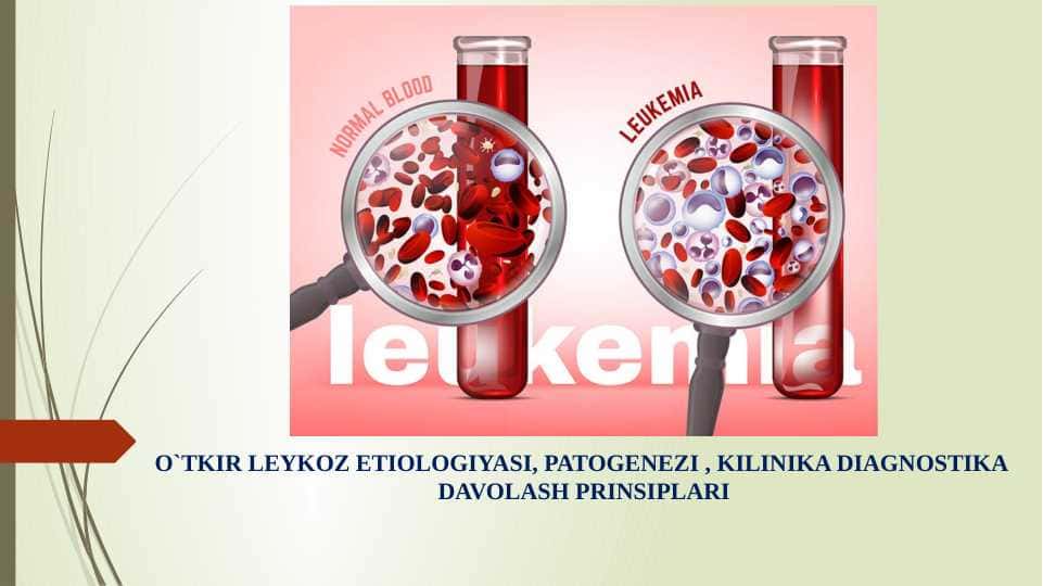 O`tkir leykoz etiologiyasi, patogenezi , kilinikasi, diagnostikasi, davolash prinsiplari