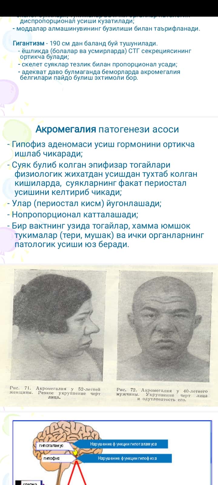 Akromegaliya