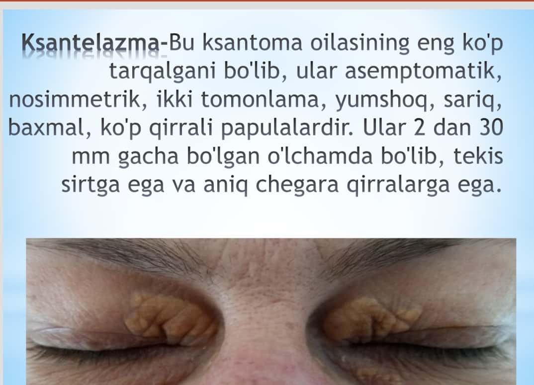 Ksantelazma , lipoma , gigroma