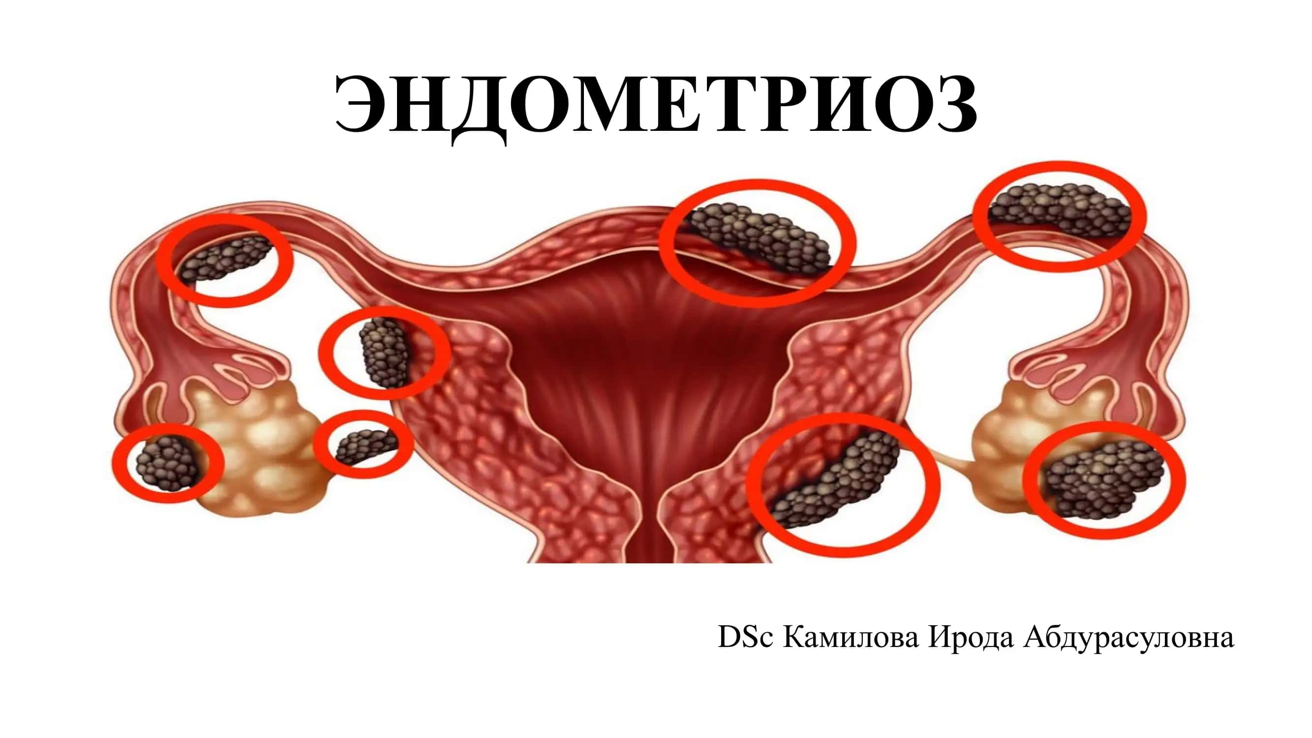 Endometrioz