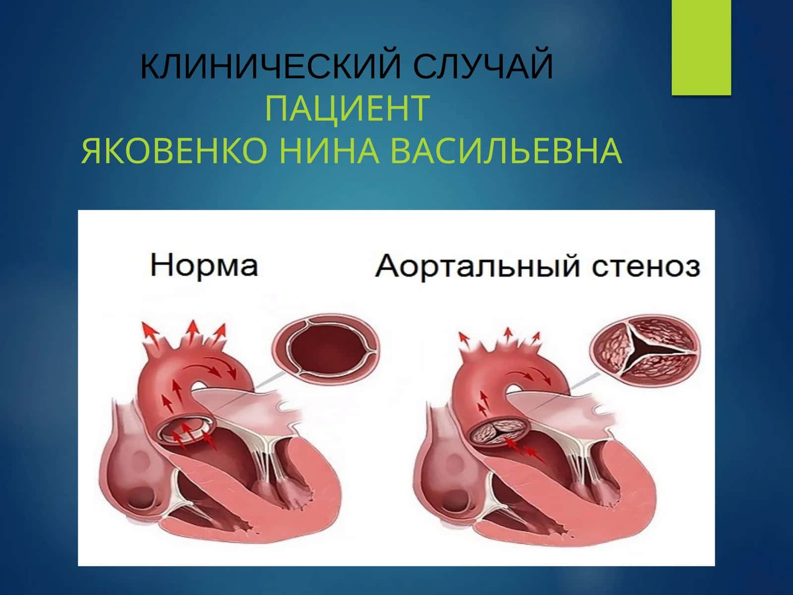 КЛИНИЧЕСКИЙ СЛУЧАЙПАЦИЕНТЯКОВЕНКО НИНА ВАСИЛЬЕВНА