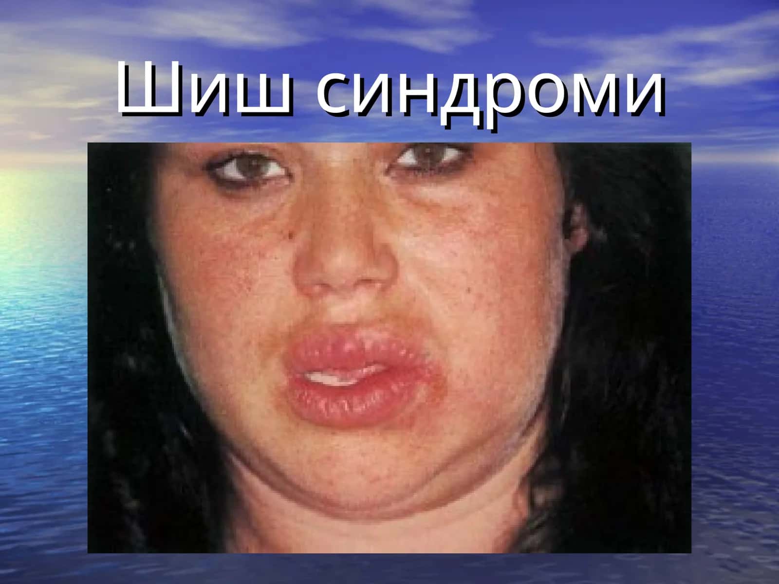 Шиш синдроми