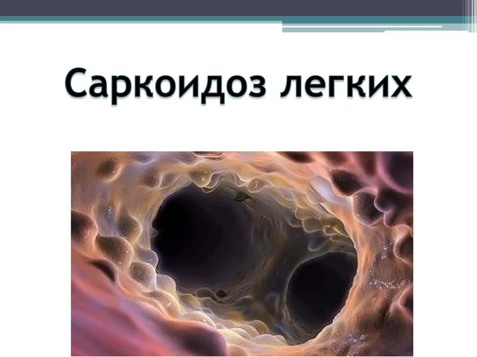 Саркоидоз легких (болезнь Бенье-Бека-Шауманна)