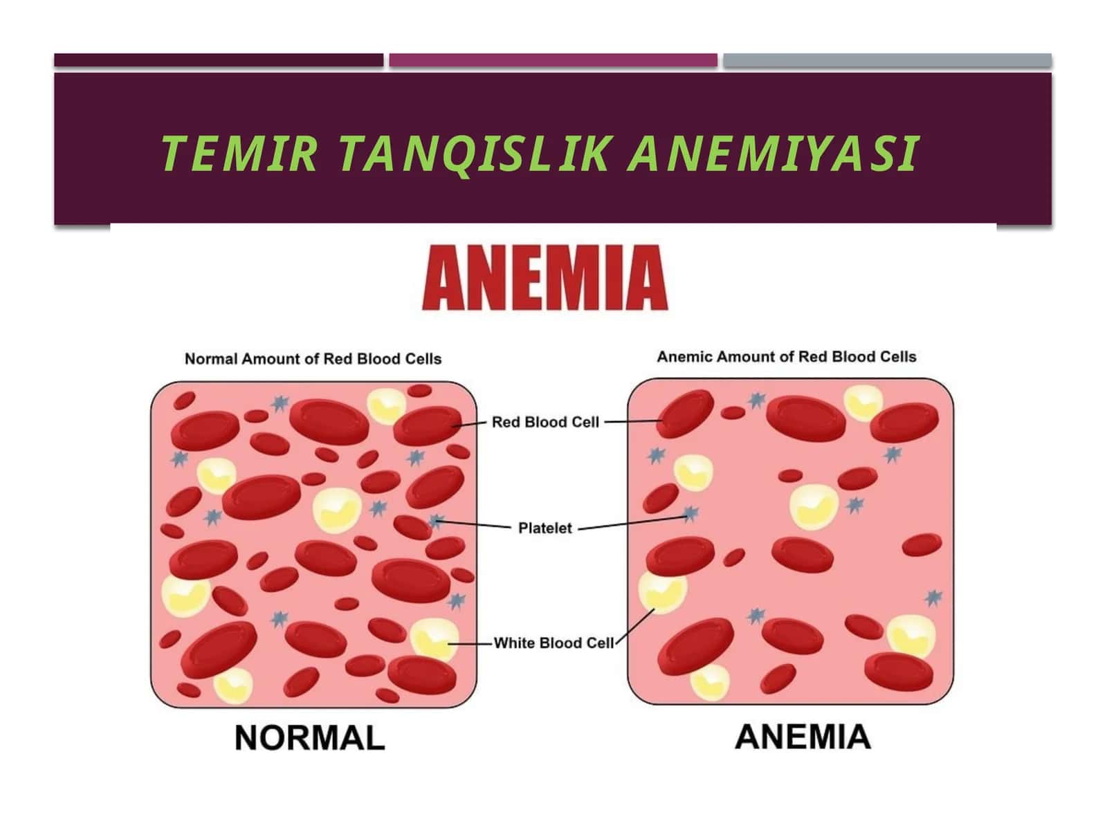 TEMIR TANQISLIK ANEMIYASI