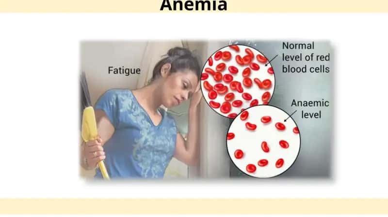 Anemia
