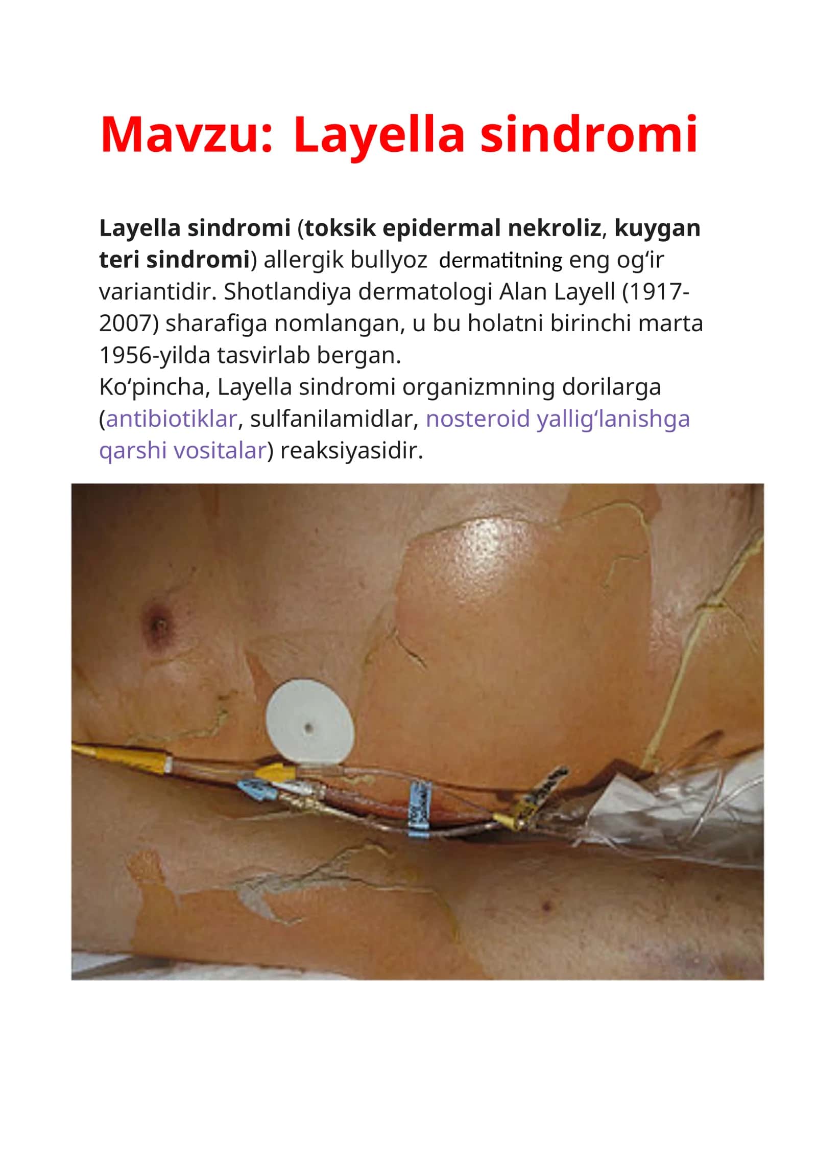 Layella sindromi