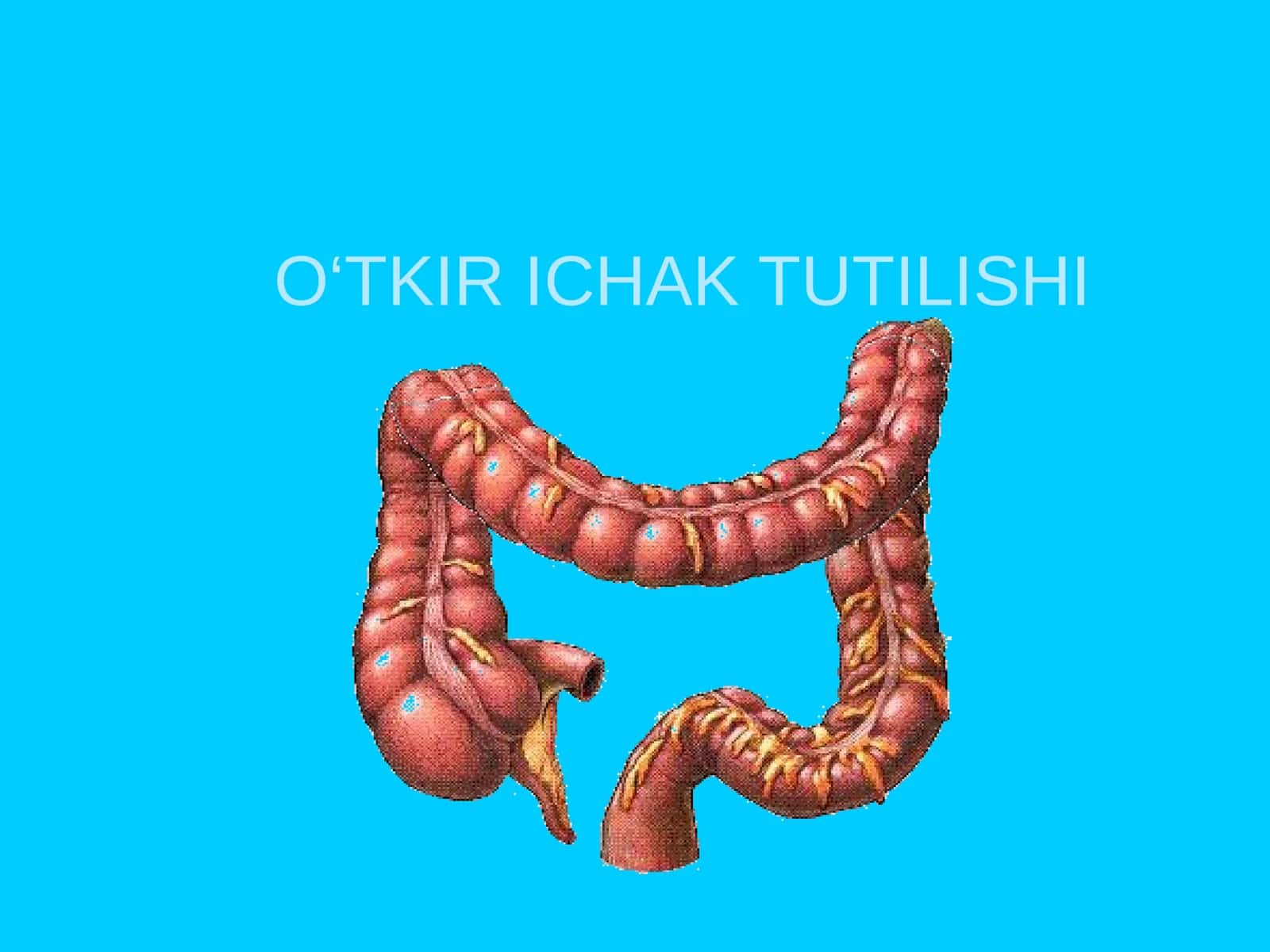 O‘TKIR ICHAK TUTILISHI