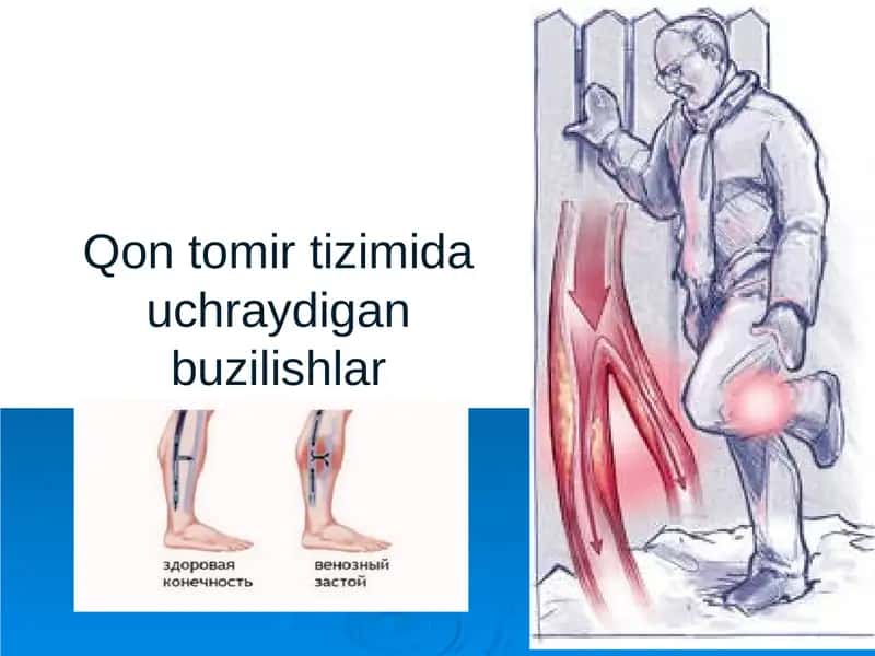 Qon tomir tizimida uchraydigan buzilishlar