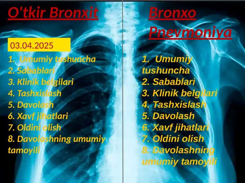 O'tkir bronxit