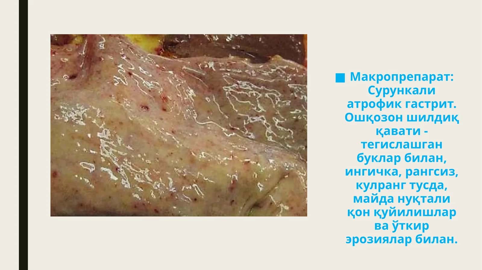 Макропрепарат: Сурункали атрофик гастрит