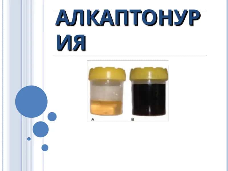 alkoptonuriya genetika