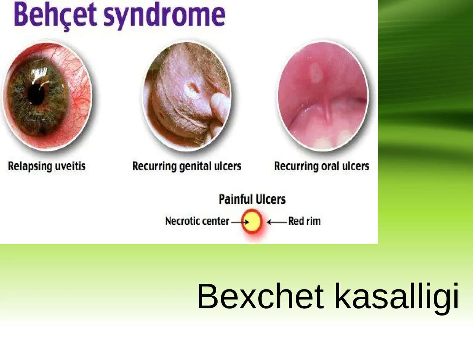 Bexchet kasalligi