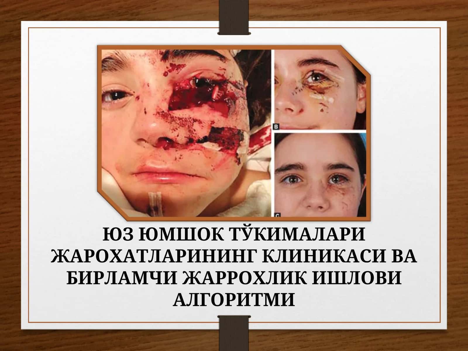ЮМШОҚ ТЎҚИМАЛАРИ ЖАРОХАТЛАРИНИНГ КЛИНИКАСИ ВА БИРЛАМЧИ ЖАРРОХЛИК ИШЛОВИ АЛГОРИТМИ