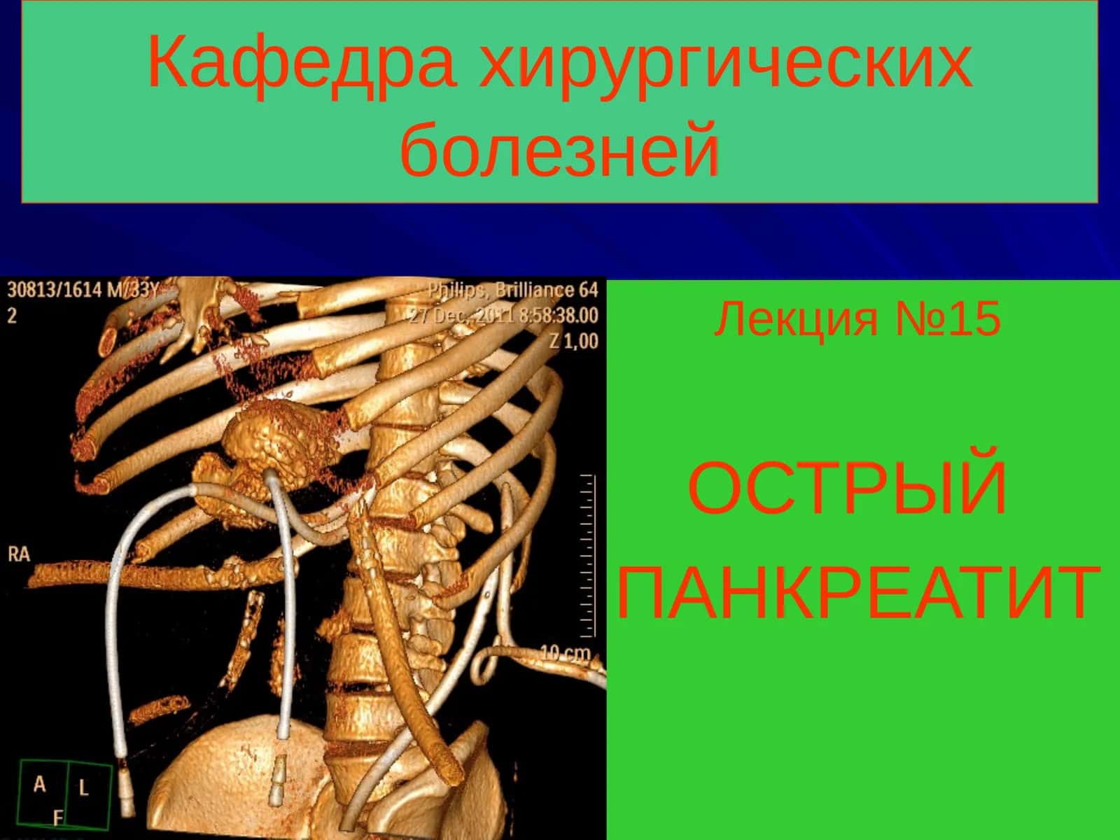 ОСТРЫЙ ПАНКРЕАТИТ