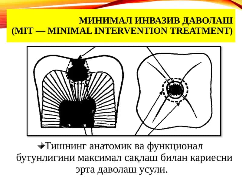МИНИМАЛ ИНВАЗИВ ДАВОЛАШ