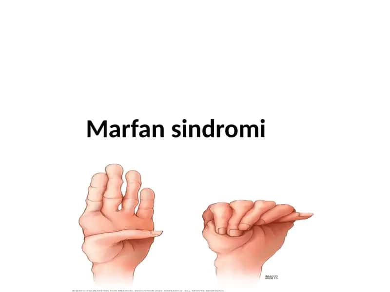 Marfan sindromi