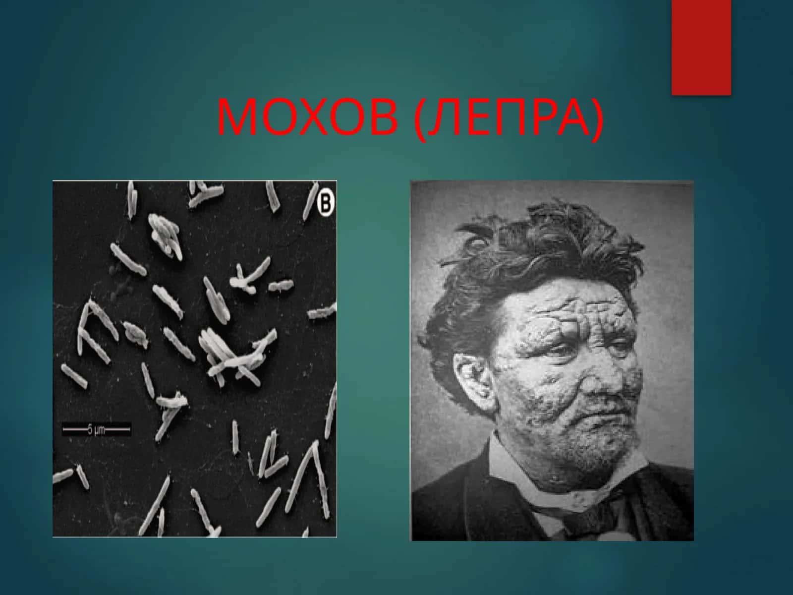 МОХОВ (ЛЕПРА)